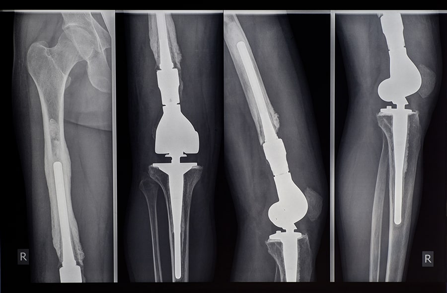 bioengineering designing prosthetic implants for human body